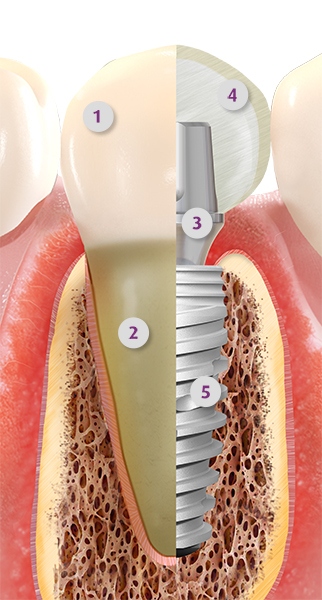 Implant zęba Toruń