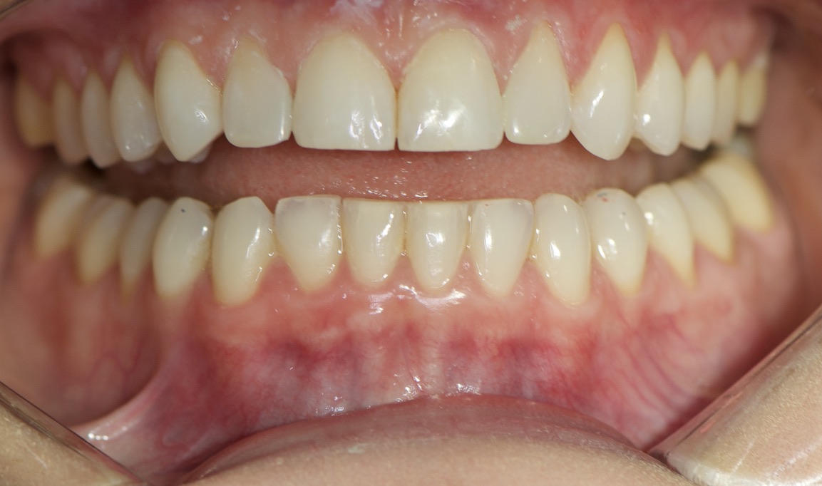 efekt po bondingu zębów
