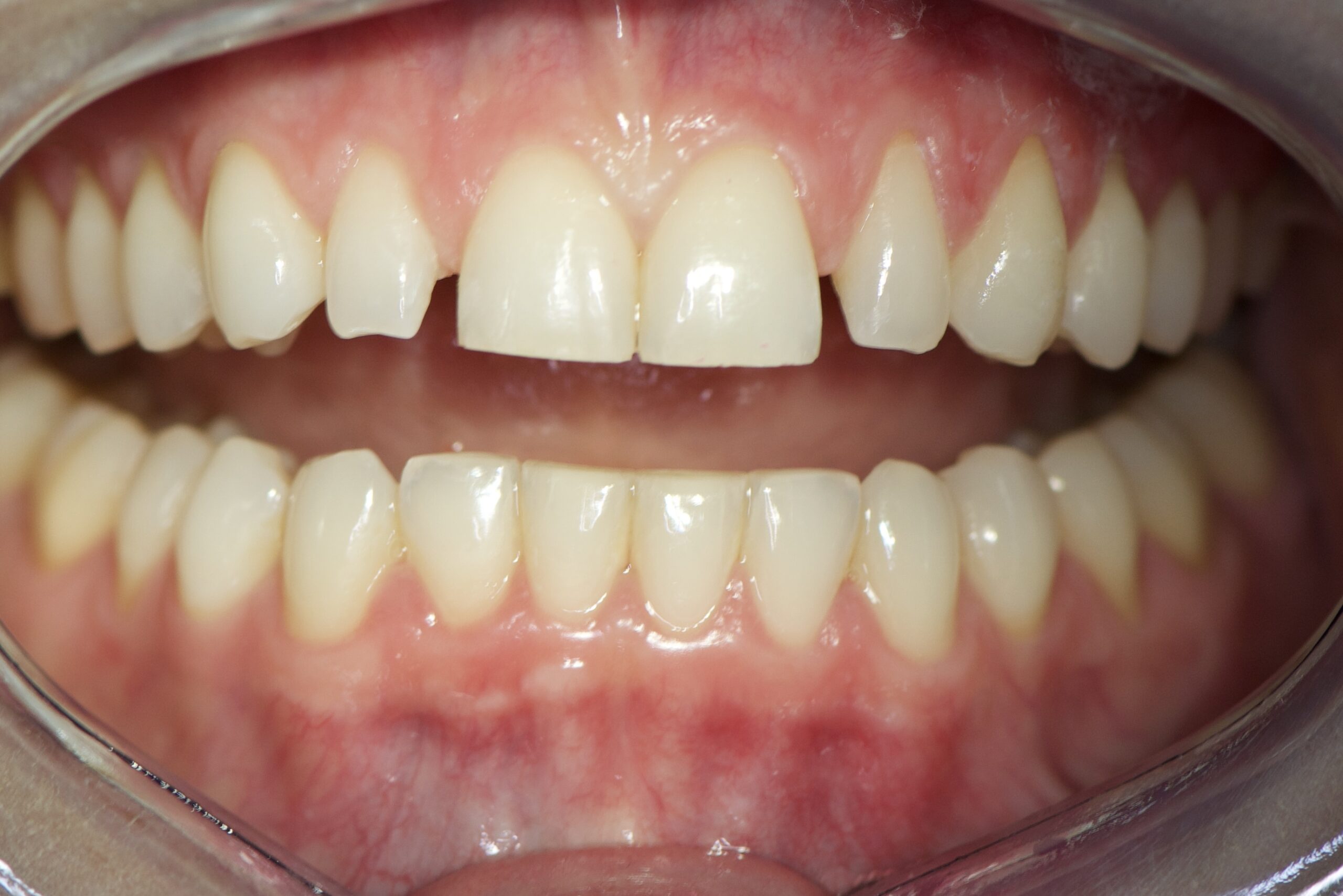 bonding zębów efekty